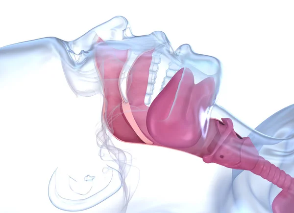 Sleep Apnea Syndrome Labeled Nasal Tongue Blocked Airway Animation — ストック写真