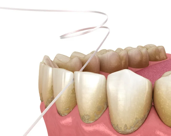 Processo Limpeza Fio Dental Ilustração Odontológica Medicamente Precisa — Fotografia de Stock