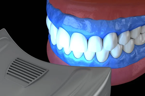 Blanqueamiento Dental Profesional Lámpara Activación Gel Concepto Ilustración — Foto de Stock