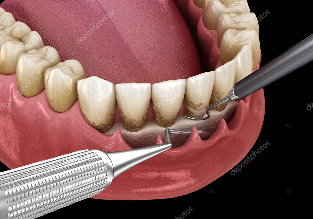 Curetaje abierto Escalado y cepillado radicular (terapia periodontal