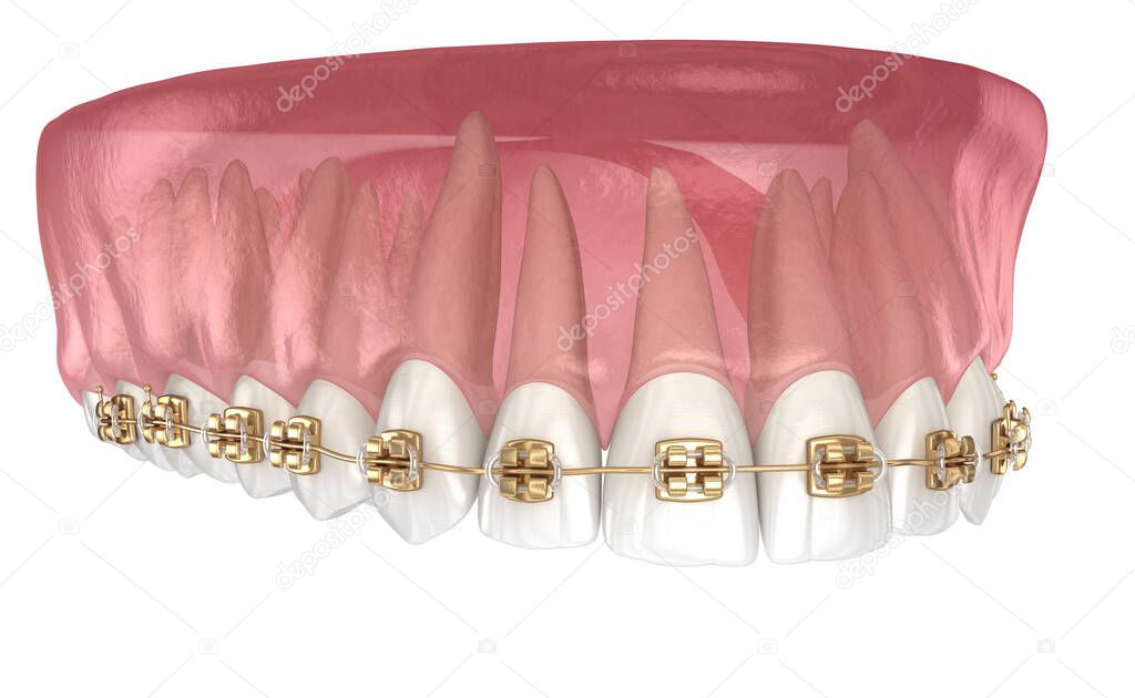 Golden braces tretament, macro view. Medically accurate dental 3D illustration