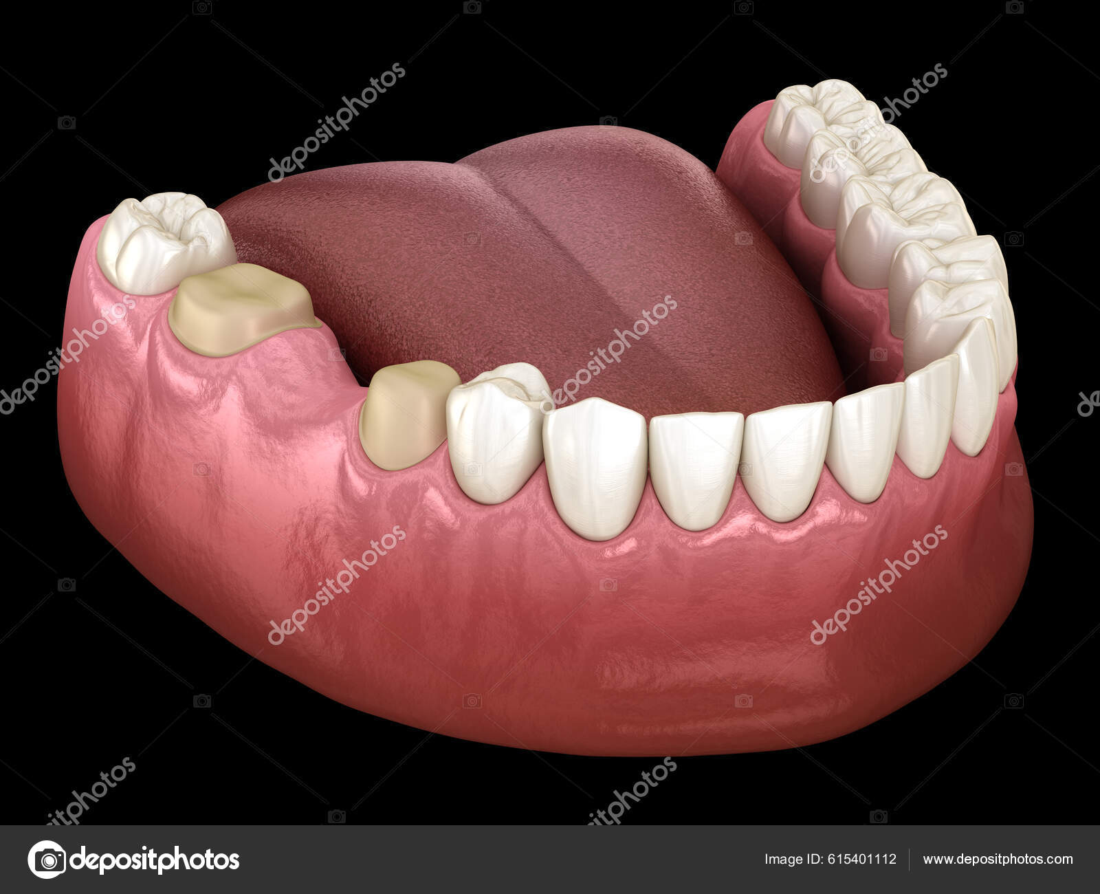 Preparated Molar Premolar Tooth Dental Bridge Placement Medically