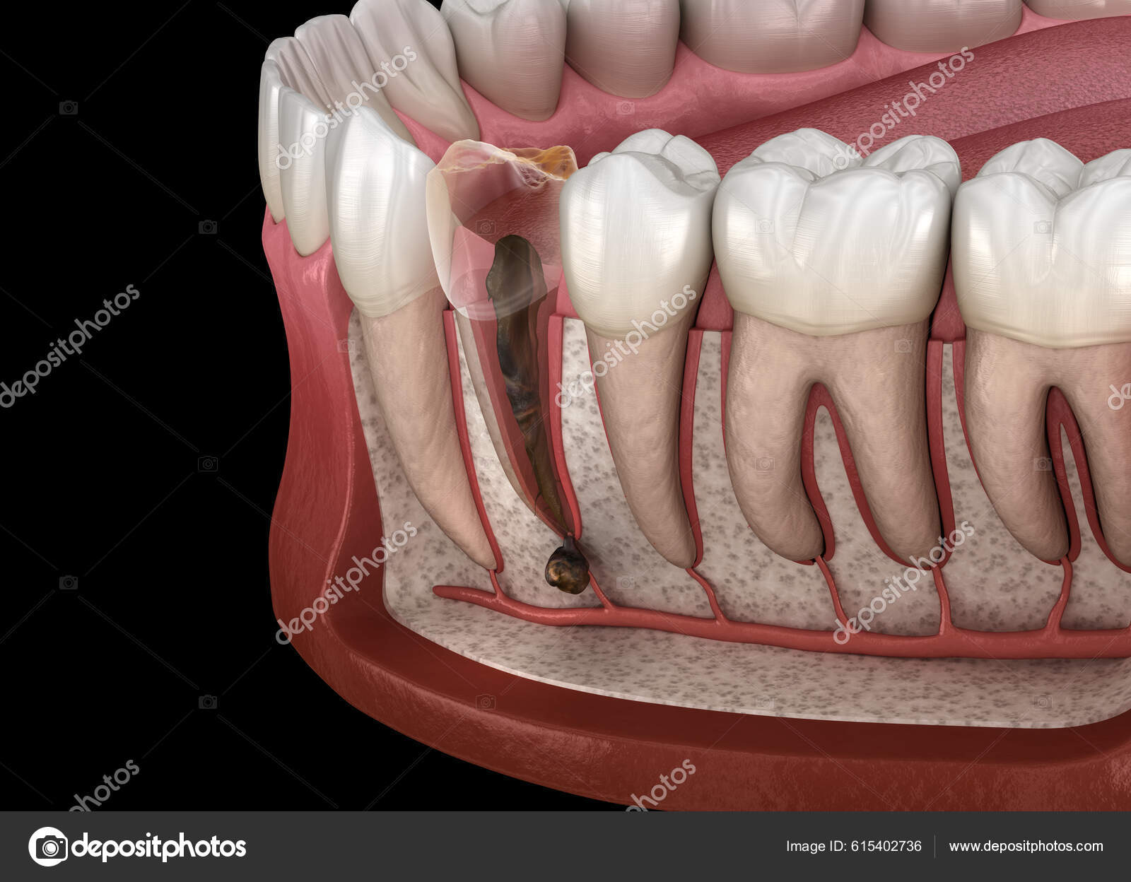 Periostitis Tooth Lump Gum Tooth Medically Accurate Dental Illustration