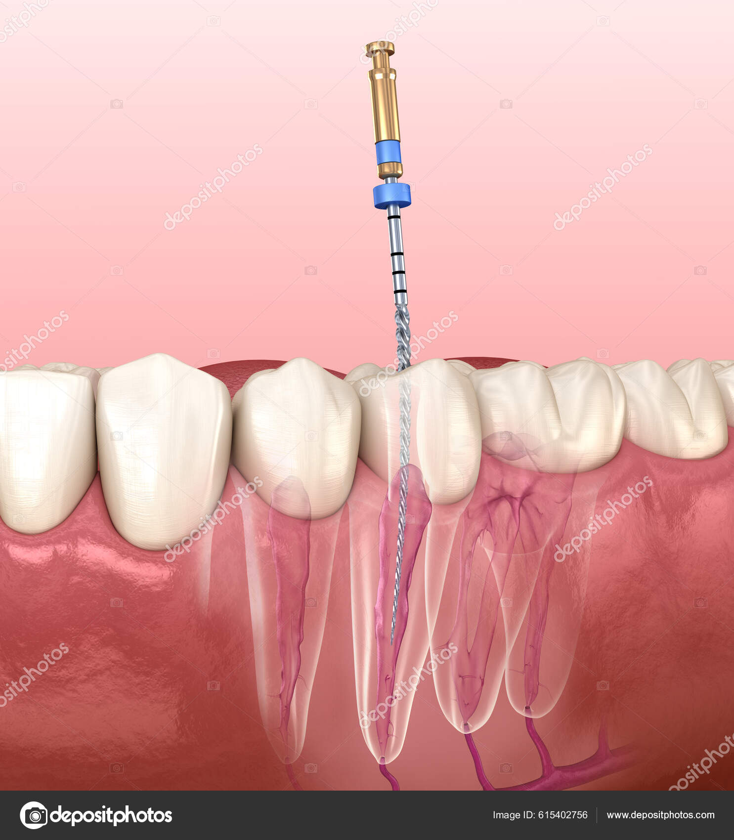 Endodontic Root Canal Treatment Process Medically Accurate Tooth