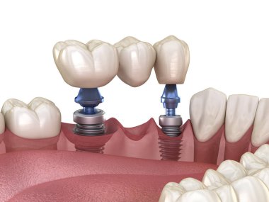 Diş köprüsü implantlarla destekleniyor. İnsan dişleri ve protez kavramının tıbben doğru üç boyutlu çizimi