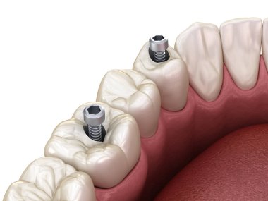 Azı dişi ve azı dişi yerleştirme implantın üzerine, vida saplantısı. Diş tedavisinin 3B illüstrasyonu