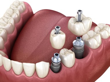 Azı dişi ve azı dişi yerleştirme implantın üzerine, vida saplantısı. Diş tedavisinin 3B illüstrasyonu