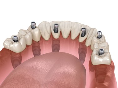 Alt çene protezi. Hepsi de implantlar ve vida saplantısıyla desteklenen 4 sistemde. Diş konseptinin tıbben doğru üç boyutlu çizimi