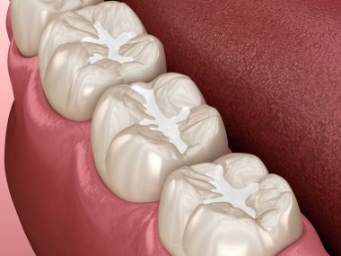 Molar Fissure diş dolguları, diş konseptinin tıbbi olarak doğru üç boyutlu çizimi