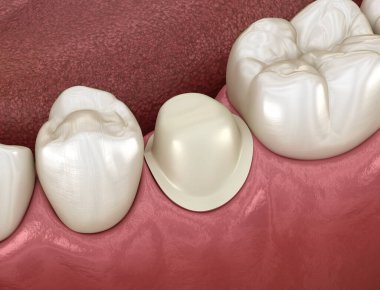 Metal-seramik diş yerleştirme için hazırlanmış azı dişi. Tıbbi olarak doğru 3B illüstrasyon