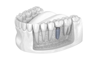 İmplantla azı dişi alınıyor. İnsan dişleri ve protez kavramının tıbben doğru üç boyutlu çizimi