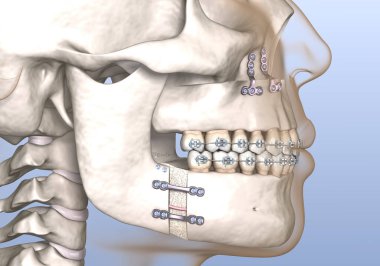Maxillomandibular ilerlemiş ameliyat. Tıbbi olarak doğru olan 3 boyutlu diş illüstrasyonu.