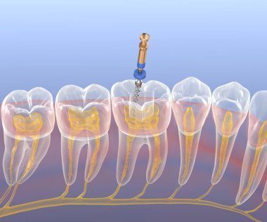 Endodontik kanal tedavisi. Tıbbi olarak doğru diş 3D illüstrasyon.