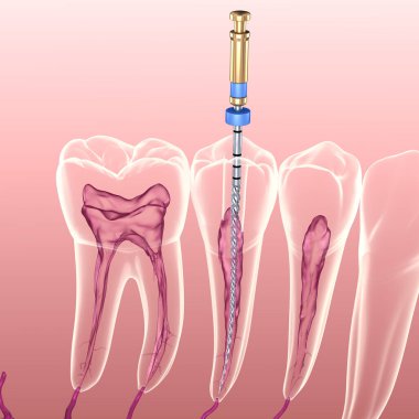 Endodontik kanal tedavisi. Tıbbi olarak doğru diş 3D illüstrasyon.