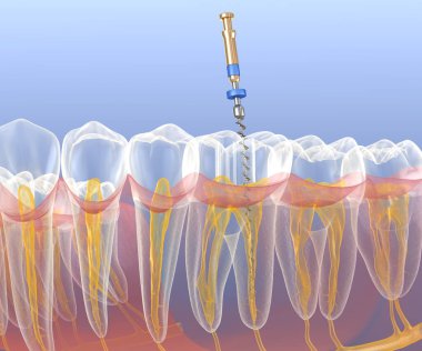 Endodontik kanal tedavisi. Tıbbi olarak doğru diş 3D illüstrasyon.