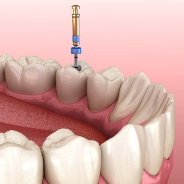 Endodontik kanal tedavisi. Tıbbi olarak doğru diş 3D illüstrasyon.