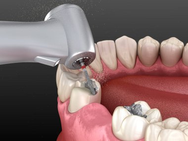 Amalgam çıkarılıyor ve seramik taç yerleştirme için hazırlanıyor. Diş konseptinin 3B illüstrasyonu
