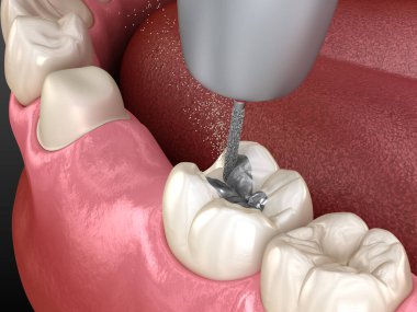 Amalgam çıkarılıyor ve seramik taç yerleştirme için hazırlanıyor. Diş konseptinin 3B illüstrasyonu