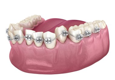 Abnormal teeth position and Clear braces tretament. Medically accurate dental 3D illustration clipart