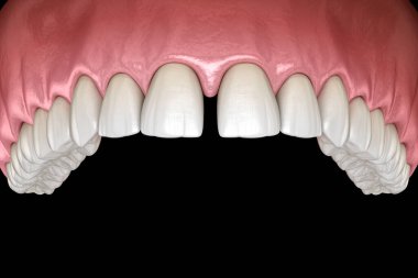 Merkezi kesici dişlerin diyabeti. Dişsel işlev bozukluğu 3 boyutlu illüstrasyon kavramı