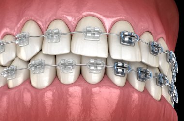 Diş telleri metal tellere karşı. Tıbbi olarak doğru olan 3D illüstrasyon, konsept.