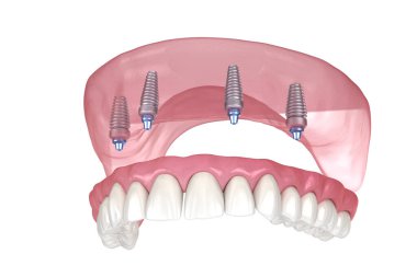 Çikletli Maxillary protezi. Hepsi de implantlarla desteklenen 4 sistemde. İnsan dişlerinin ve protezlerinin tıbbi açıdan doğru üç boyutlu çizimi
