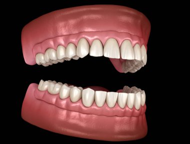 Çikletli Maxillary ve Mandibular protez hepsi de implantlarla desteklenen 4 sistemde. İnsan dişlerinin ve protezlerinin tıbbi açıdan doğru üç boyutlu çizimi