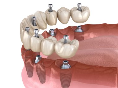 Çikletli çene protezi. Hepsi de implantlarla desteklenen 6 sistemde. İnsan dişleri ve protez kavramının tıbben doğru üç boyutlu çizimi