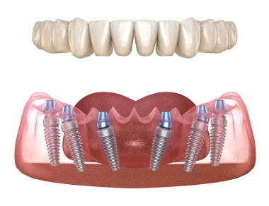Çene protezi. Hepsi de implantlarla desteklenen 6 sistemde. İnsan dişleri ve protez kavramının tıbben doğru üç boyutlu çizimi