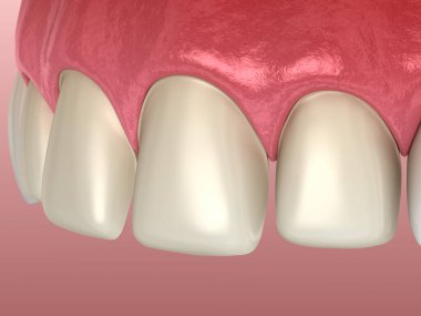 Merkezi kesici diş ve yanal kesici diş üzerinde Venedik kurulum prosedürü için diş hazırlığı. Tıbbi olarak doğru diş 3D illüstrasyon