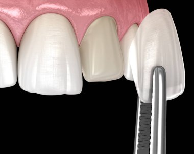 Veneer installation procedure over central incisor. Medically accurate tooth 3D illustration clipart