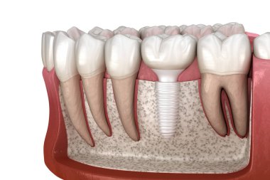 Seramik implantın üzerine azı dişi yerleştirilmiş. Diş implantasyonunun tıbben doğru üç boyutlu çizimi