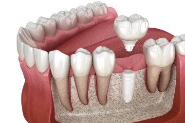 Seramik implantın üzerine azı dişi yerleştirilmiş. Diş implantasyonunun tıbben doğru üç boyutlu çizimi