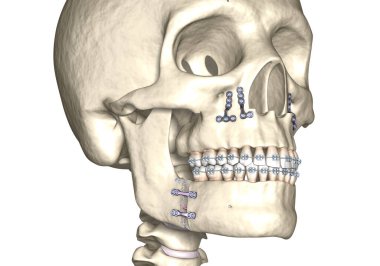 Mandibular Gelişim Cerrahisi. Tıbbi olarak doğru olan 3 boyutlu diş illüstrasyonu.