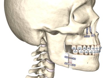 Mandibular Gelişim Cerrahisi. Tıbbi olarak doğru olan 3 boyutlu diş illüstrasyonu.