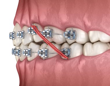 Lastik ve metal teller diş düzeltme için. Tıbbi olarak doğru olan 3 boyutlu diş illüstrasyonu