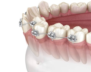 Anormal diş pozisyonu ve metal diş telleriyle düzeltme. Tıbbi olarak doğru olan 3 boyutlu diş illüstrasyonu