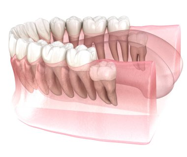 Bilgelik dişinin dikey etkisi. Tıbbi olarak doğru diş 3D illüstrasyon