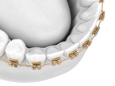 Altın diş telli sağlıklı dişler, beyaz diş konsepti, 3 boyutlu diş çizimi