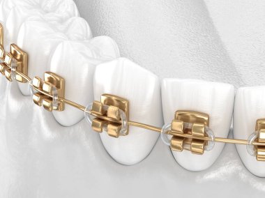 Altın diş telli sağlıklı dişler, beyaz diş konsepti, 3 boyutlu diş çizimi