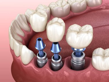 3 implantın üzerine 3 diş yerleştirme - kavram. İnsan dişlerinin ve takma dişlerinin 3 boyutlu çizimi