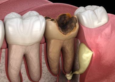 Periostitis tooth - Lump on Gum Above Tooth. Medically accurate dental 3D illustration clipart