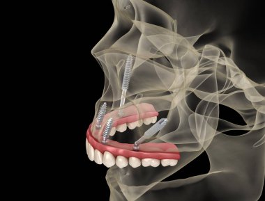 Elmacık kemiği implantları tarafından desteklenen Maxillary protezi. İnsan dişlerinin ve protezlerinin tıbbi açıdan doğru üç boyutlu çizimi