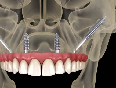 Elmacık kemiği implantları tarafından desteklenen Maxillary protezi. İnsan dişlerinin ve protezlerinin tıbbi açıdan doğru üç boyutlu çizimi