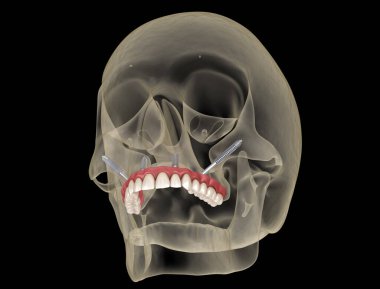Elmacık kemiği implantları tarafından desteklenen Maxillary protezi. İnsan dişlerinin ve protezlerinin tıbbi açıdan doğru üç boyutlu çizimi