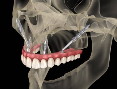 Elmacık kemiği implantları tarafından desteklenen Maxillary protezi. İnsan dişlerinin ve protezlerinin tıbbi açıdan doğru üç boyutlu çizimi