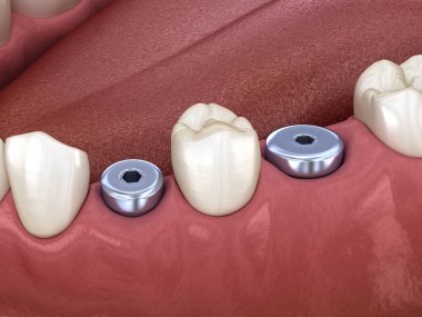 Kapak vidası - geçici aşınma. İnsan dişleri ve protez kavramının tıbben doğru üç boyutlu çizimi