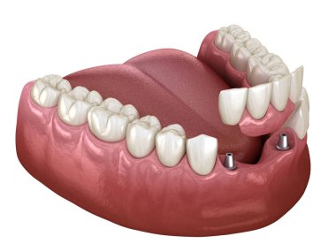 Ön diş köprüsü implantlarla destekleniyor. Diş konseptinin tıbben doğru 3D animasyonu