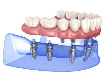 Çikletli Maxillary ve Mandibular protez. Hepsi de implantlarla desteklenen 8 sistemde. İnsan dişlerinin ve protezlerinin tıbbi açıdan doğru üç boyutlu çizimi