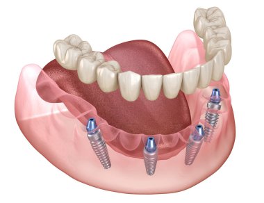 Alt çene protezi. Hepsi de implantlarla desteklenen 4 sistemde. İnsan dişleri ve protez kavramının tıbben doğru üç boyutlu çizimi